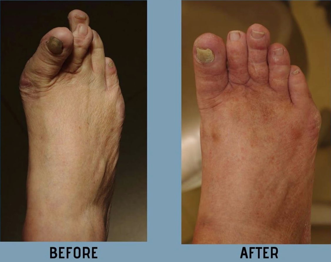 Corn Removal Surgery & Callus Treatment in Irvine Orange County