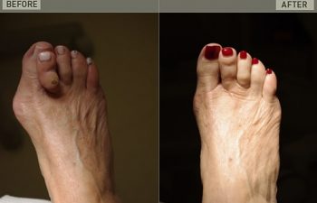 Before/After Foot