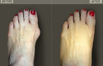 Before/After Foot