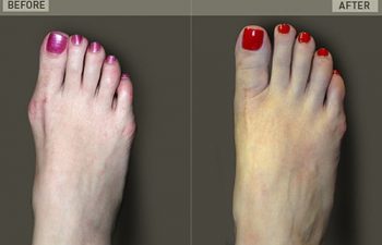 Before/After Foot