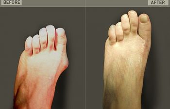 Before/After Foot