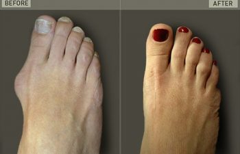 Before/After Foot