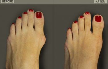 Before/After Foot