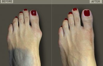 Before/After Foot