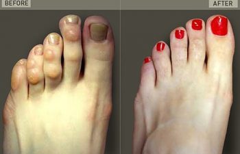 Before/After Foot