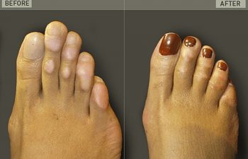 Before/After Foot