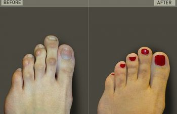 Before/After Foot