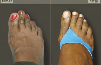 Before/After Foot