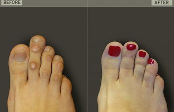 Before/After Foot